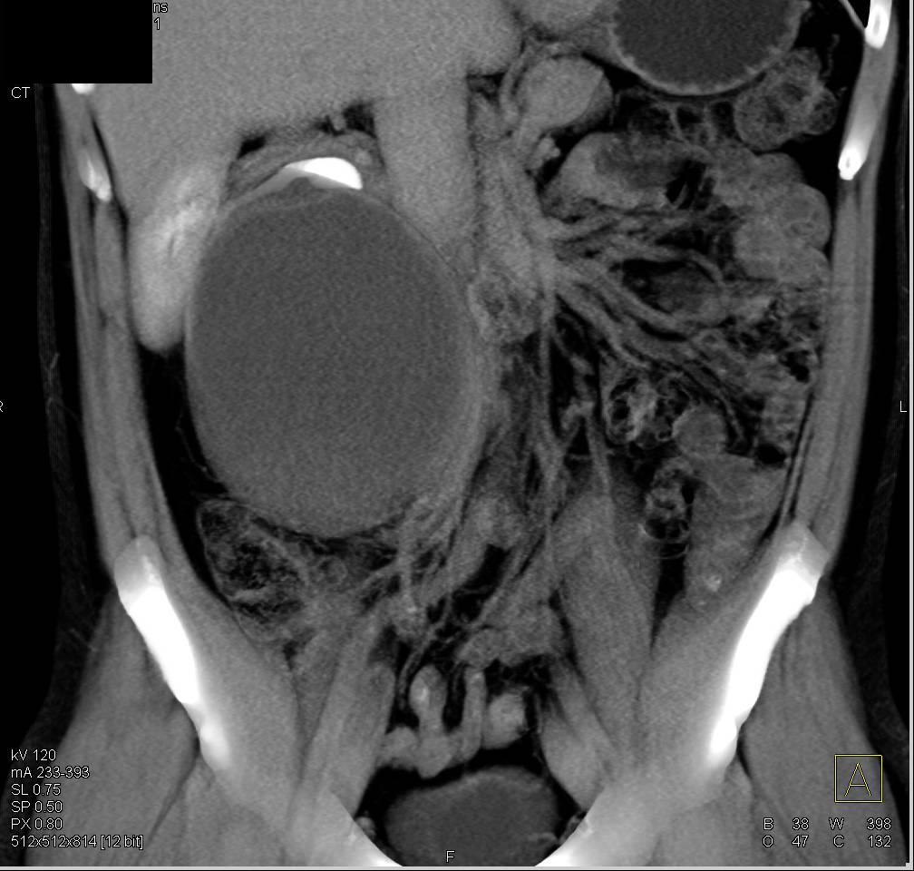 Renal Cell Carcinoma in the Wall of a Renal Cyst - CTisus CT Scan