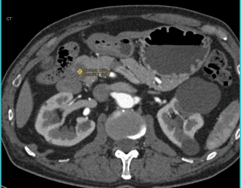 Fibromuscular Dysplasia (FMD) both Renal Arteries and Cystic Lesion Head of Pancreas - CTisus CT Scan