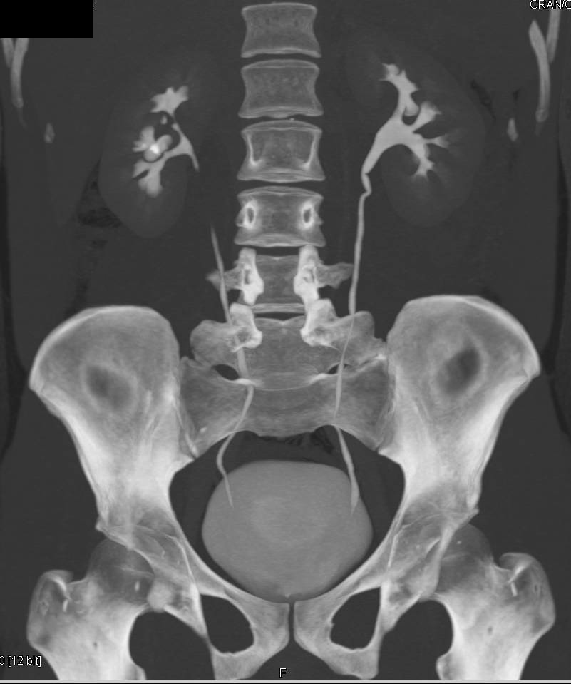 Stone in Calyx Right Kidney Without Obstruction - CTisus CT Scan