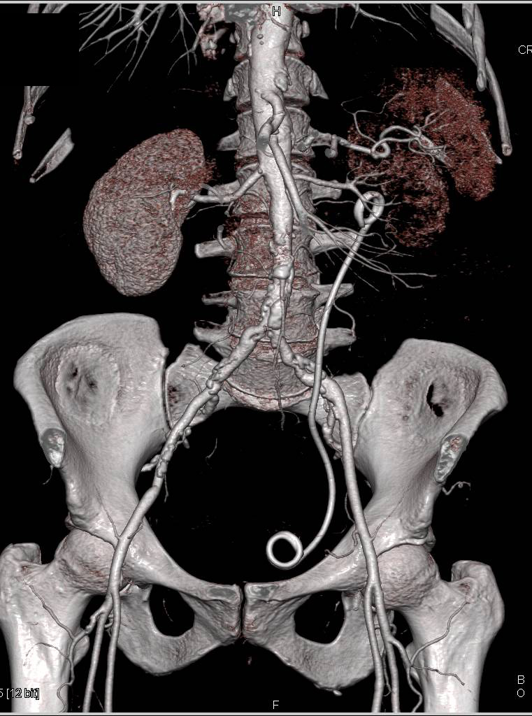 Thinning of Cortex of Left Kidney with Stent into Bladder on CT Urography - CTisus CT Scan