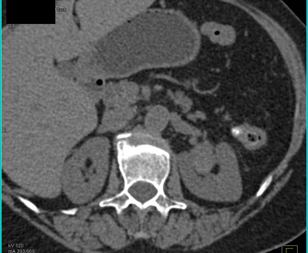 2cm Left Renal Cell Carcinoma - CTisus CT Scan