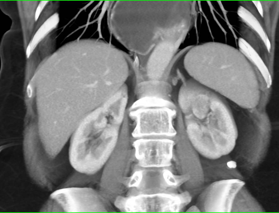 with Multiphas Exam 2 cm Papillary Renal Cell carcinoma - CTisus CT Scan