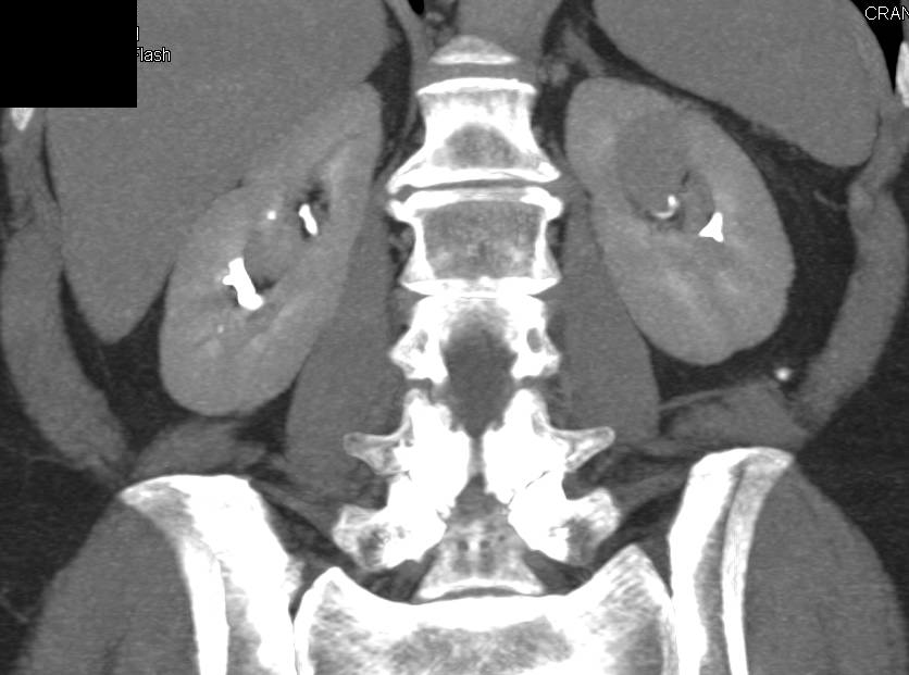 Papillary Left Renal Cell Carcinoma - CTisus CT Scan