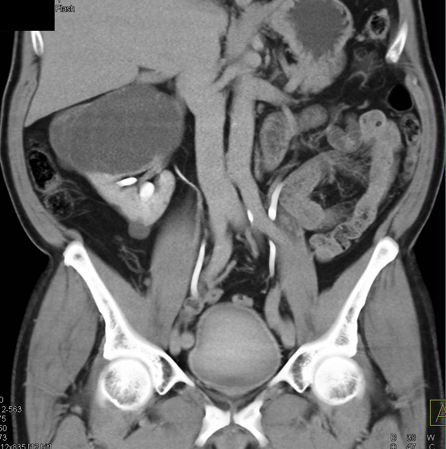 Complex Cyst Right Kidney - CTisus CT Scan