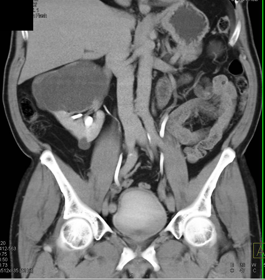 Bosniak 2F Renal Cyst - CTisus CT Scan