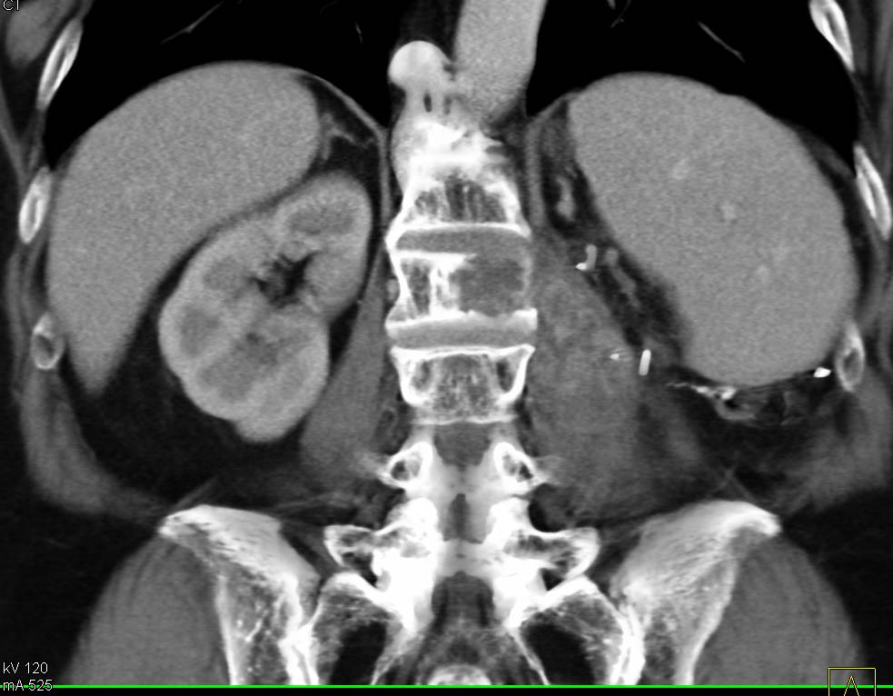 Recurrent Renal Cell Carcinoma to Psoas Muscle and to the Spine - CTisus CT Scan