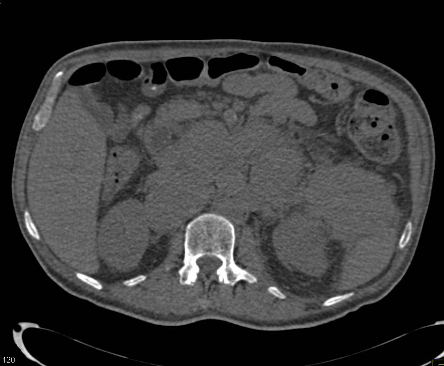 Renal Cell Carcinoma with Bulky Adenopathy - CTisus CT Scan