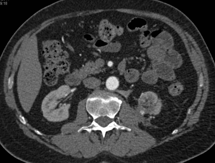 Changes Post Left Partial Nephrectomy - CTisus CT Scan