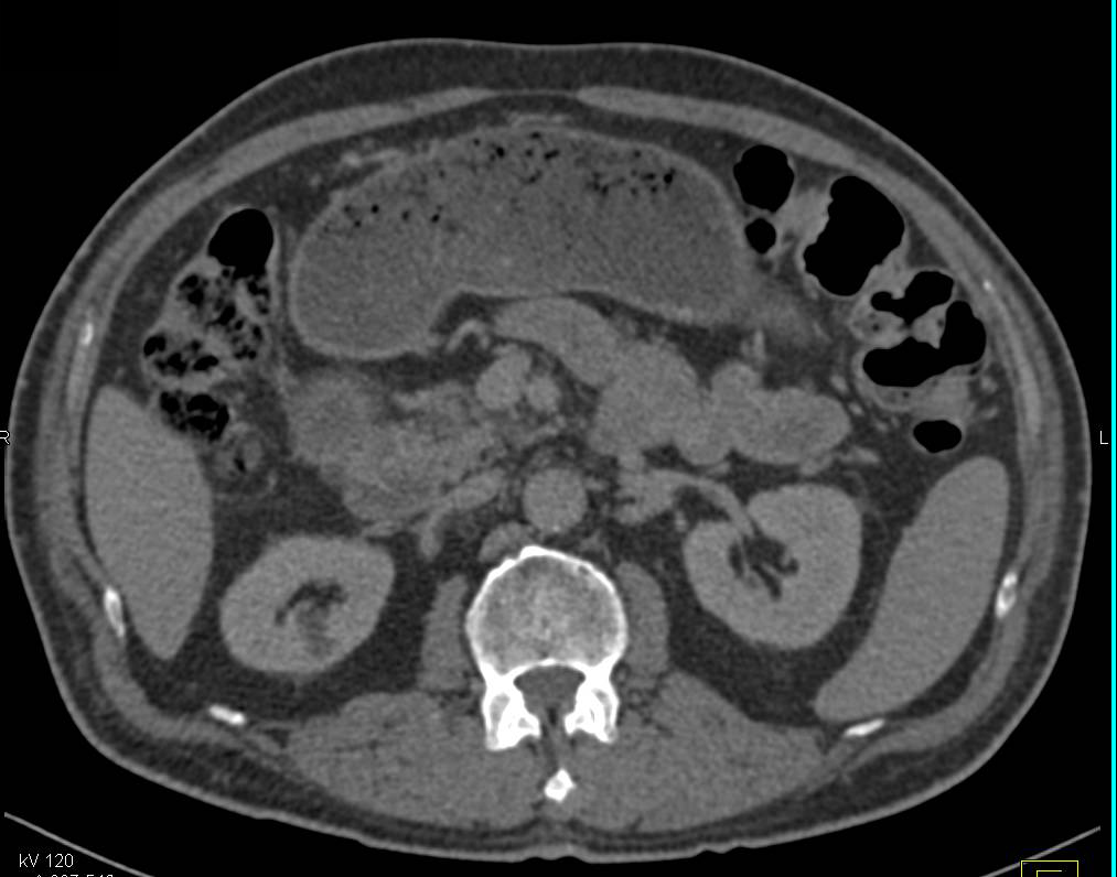 Right Pelvic Transplant Kidneys - CTisus CT Scan