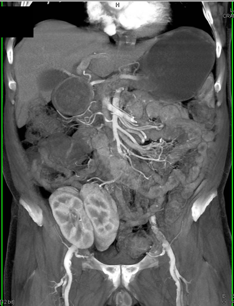 Renal Transplant in Right Lower Quadrant - CTisus CT Scan