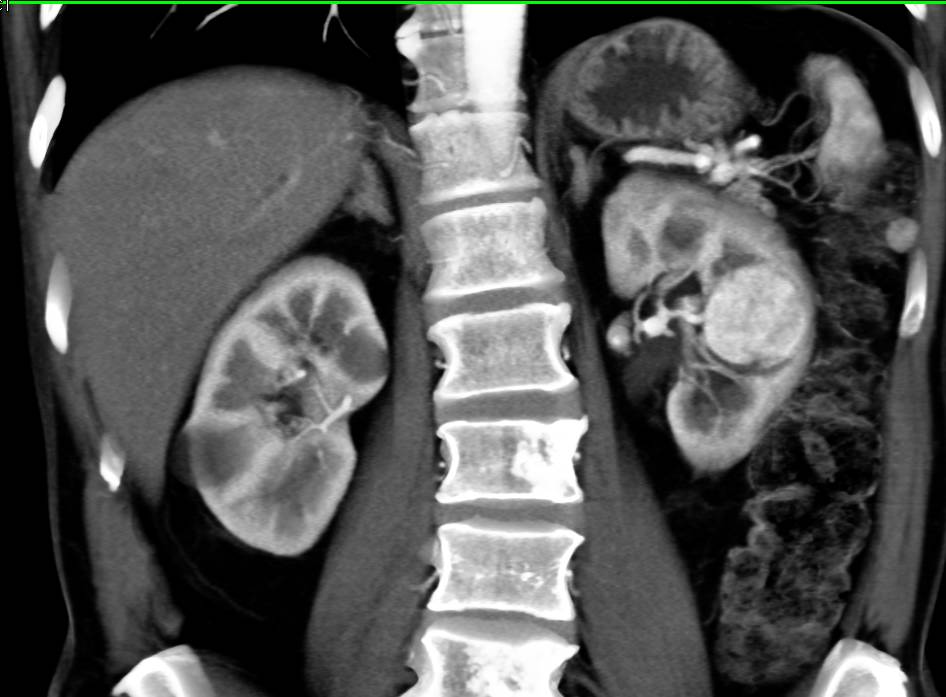 Renal Cell Carcinoma in a Patient with Pancreatic Cancer - CTisus CT Scan