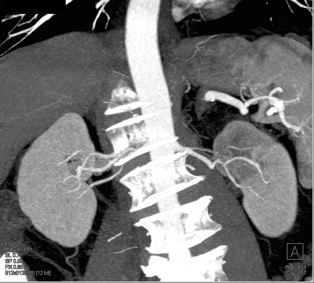 Transitional Cell Carcinoma of the Left Kidney - CTisus CT Scan