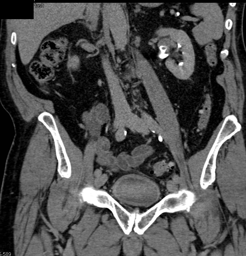 Transitional Cell Carcinoma of the Left Kidney on CT Urograms - CTisus CT Scan