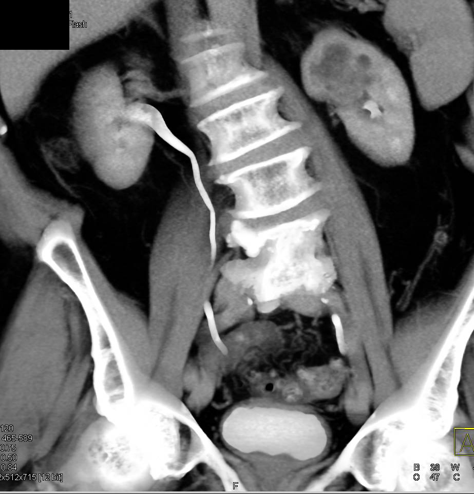 Transitional Cell Carcinoma Left Kidney in Multiple Phases - CTisus CT Scan