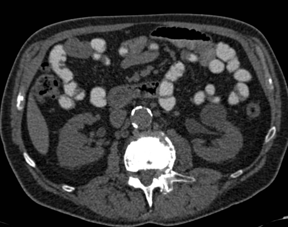 Subtle Transitional Cell Carcinoma Left Kidney Involves Renal Pelvis - CTisus CT Scan