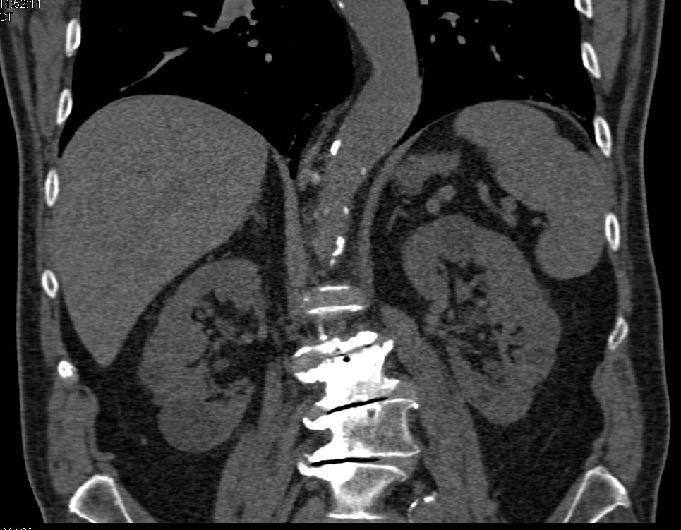 Transitional Cell Cancer (TCC) Left Kidney Best Seen on CT Urogram - CTisus CT Scan