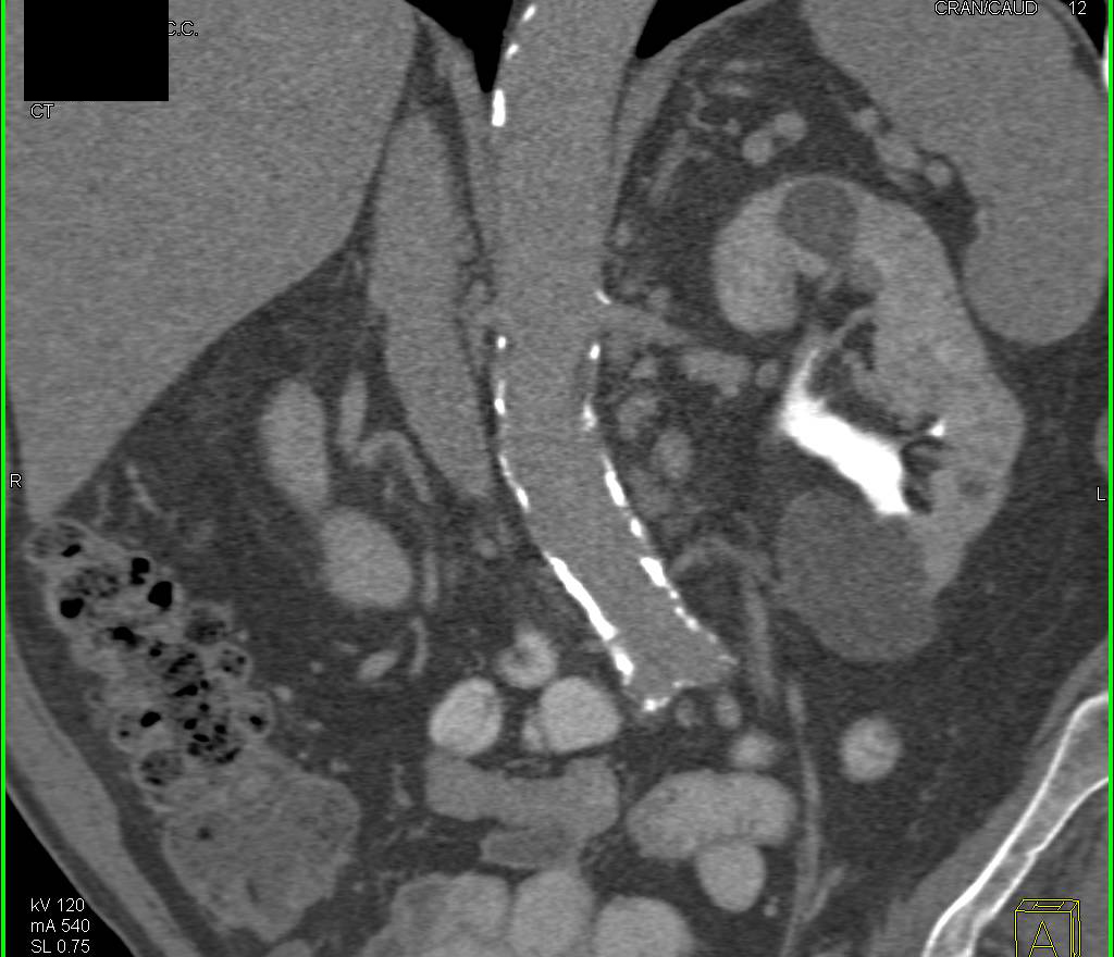 Renal Cysts - CTisus CT Scan