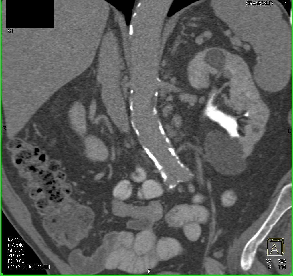 Transitional Cell Carcinoma Left Kidney - CTisus CT Scan