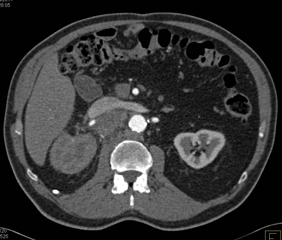 Transitional Cell Carcinoma Right Kidney with Adenopathy - CTisus CT Scan