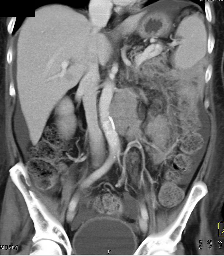 Renal Cell Carcinoma with Bulky Adenopathy and Carcinomatosis - CTisus CT Scan