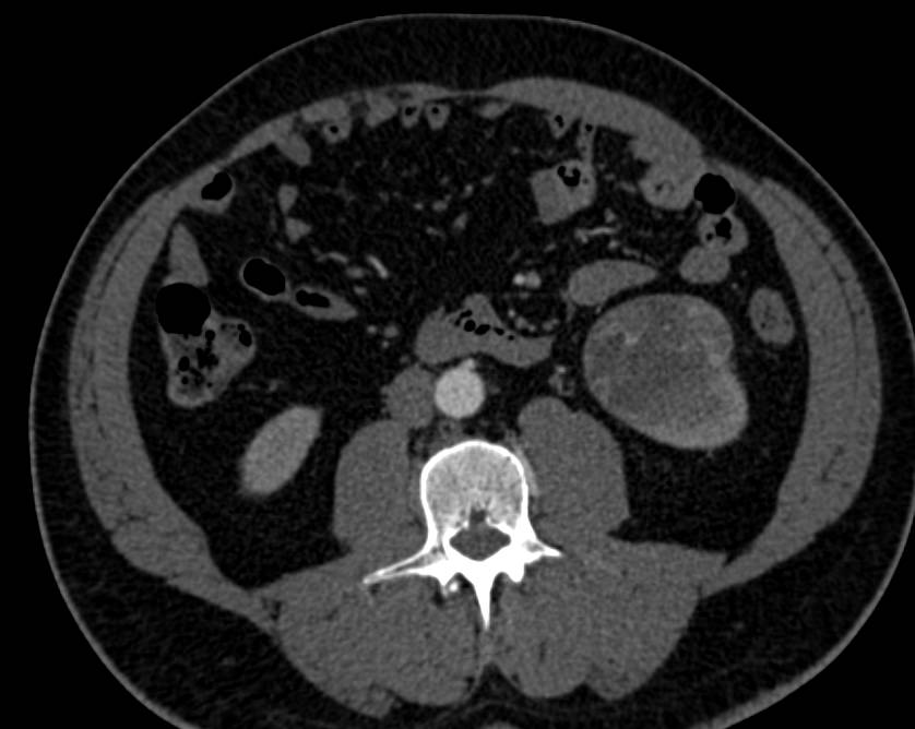 Cystic Left Renal Cell Carcinoma - CTisus CT Scan