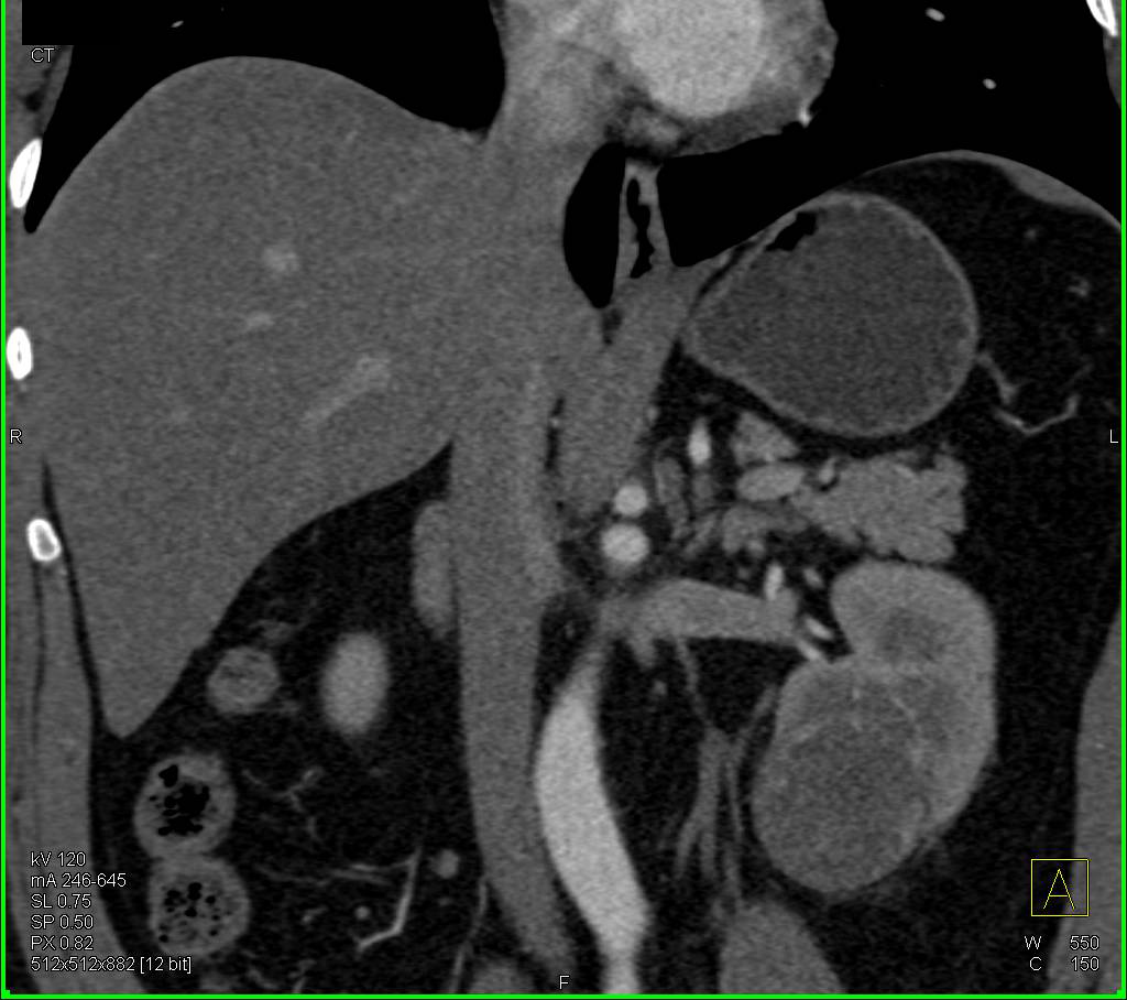 Cystic Renal Cell Carcinoma - CTisus CT Scan