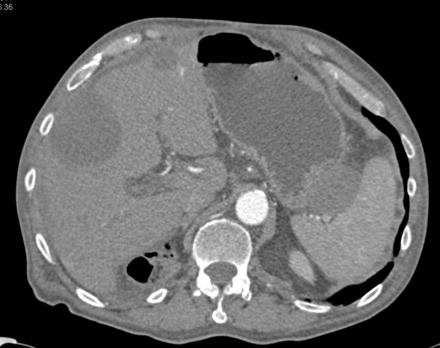 Right Nephrectomy with Normal Function Left Kidney - CTisus CT Scan