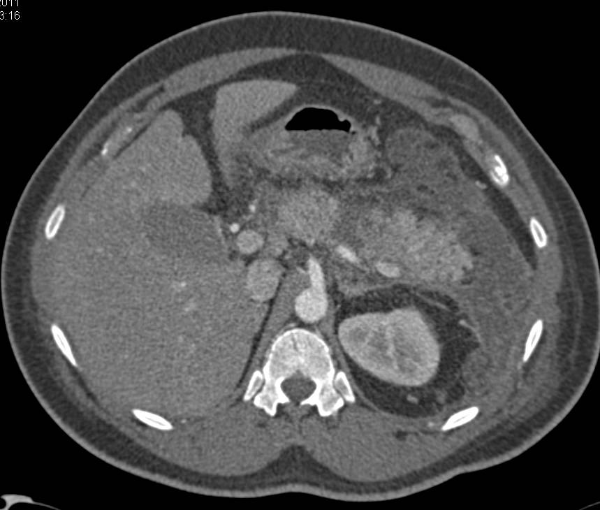 Acute Pancreatitis with Left Pararenal Space Involvement - CTisus CT Scan