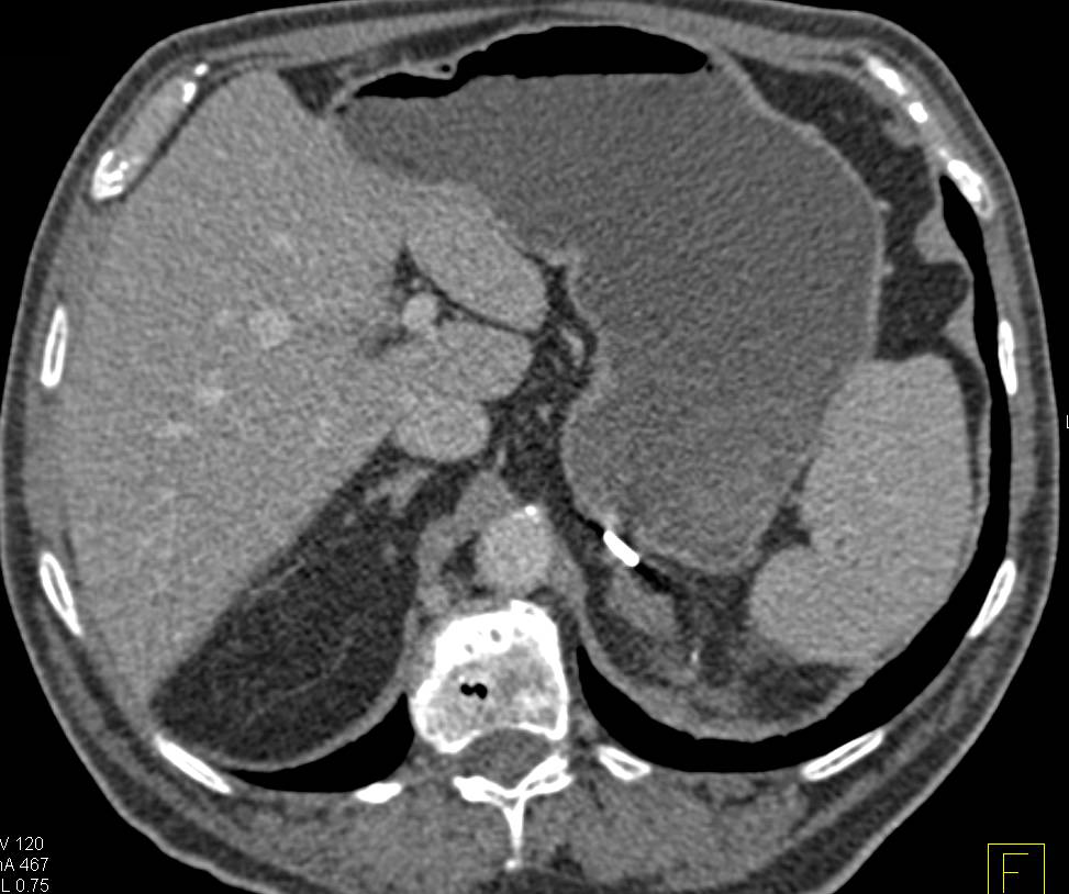 Changes Following Partial Left Nephrectomy - CTisus CT Scan