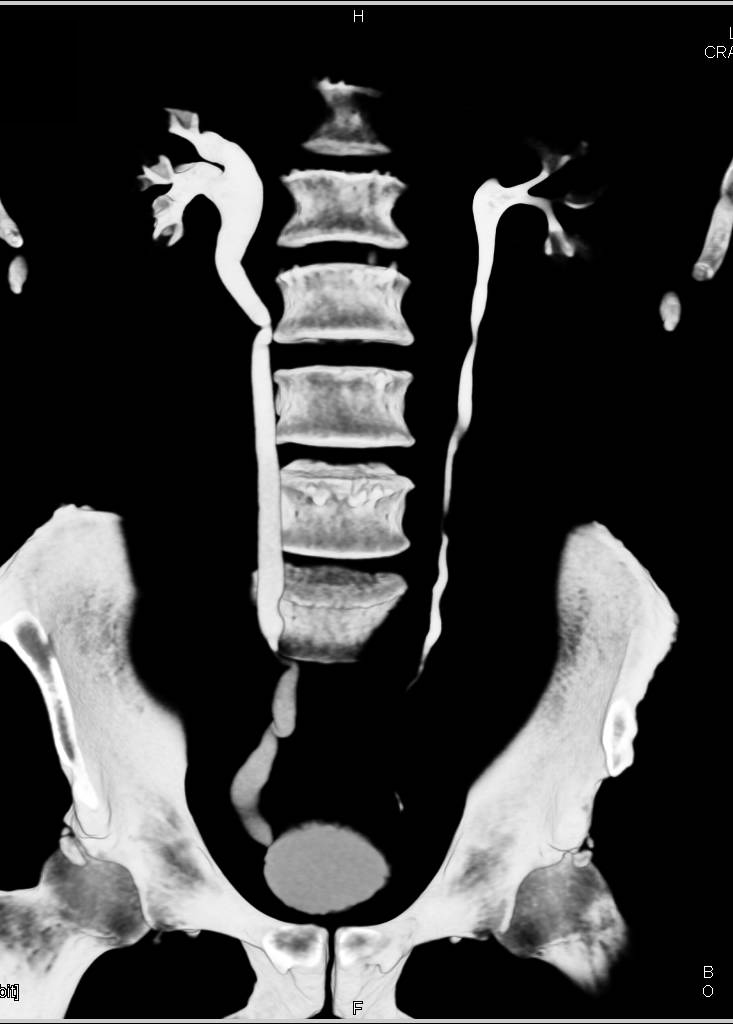 Stone Passing Distal Right Ureter - CTisus CT Scan