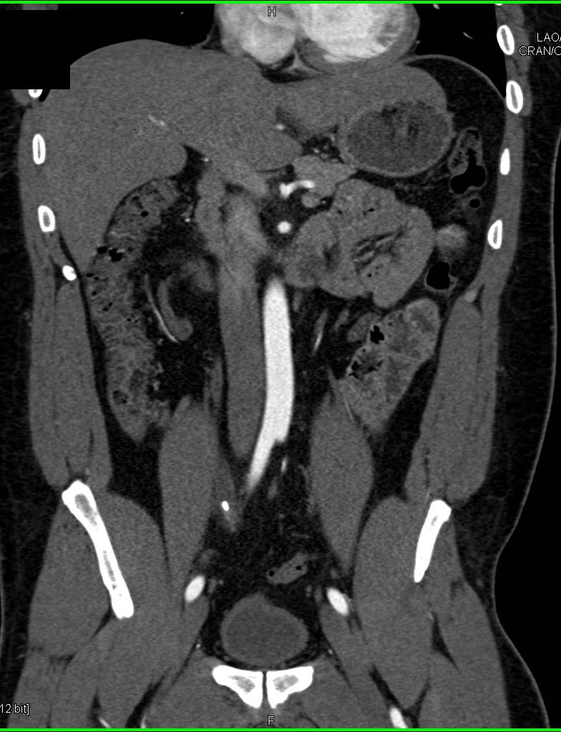 Right Hydronephrosis due to Obstructing Stone in Right Ureter - CTisus CT Scan