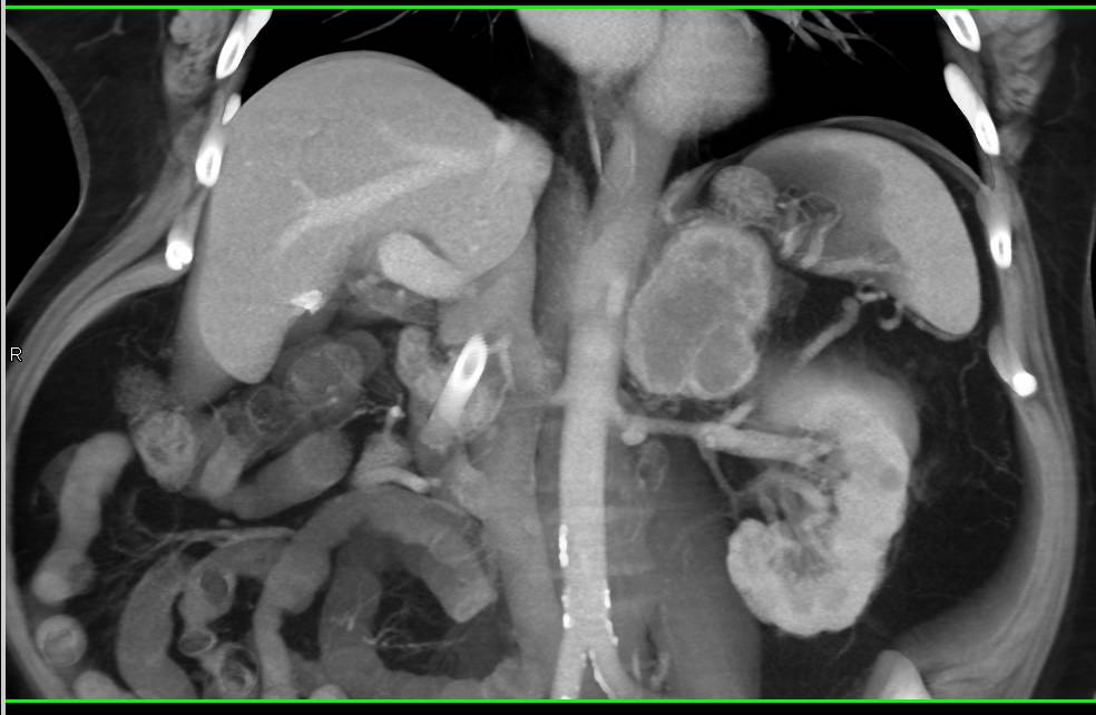 Renal Cell Carcinoma with Nephrectomy and Adrenal Metastases - CTisus CT Scan