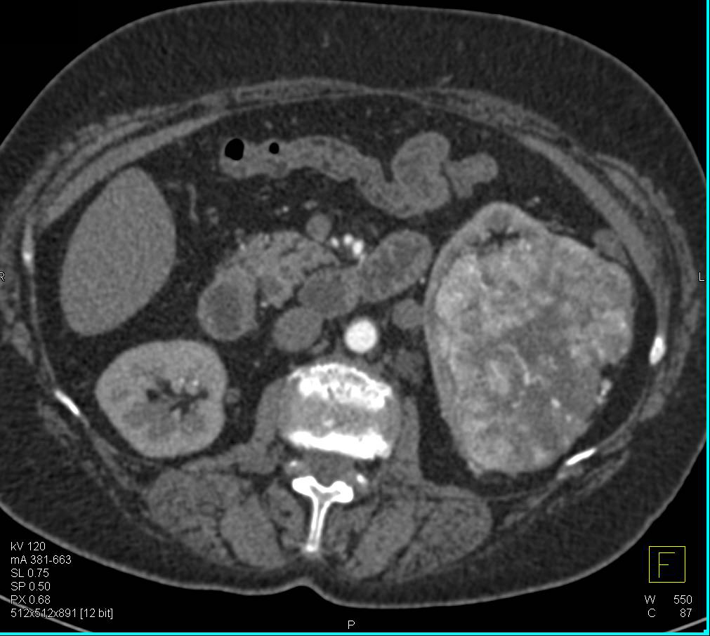 Clear Cell Renal Cell Carcinoma with Neovascularity - CTisus CT Scan