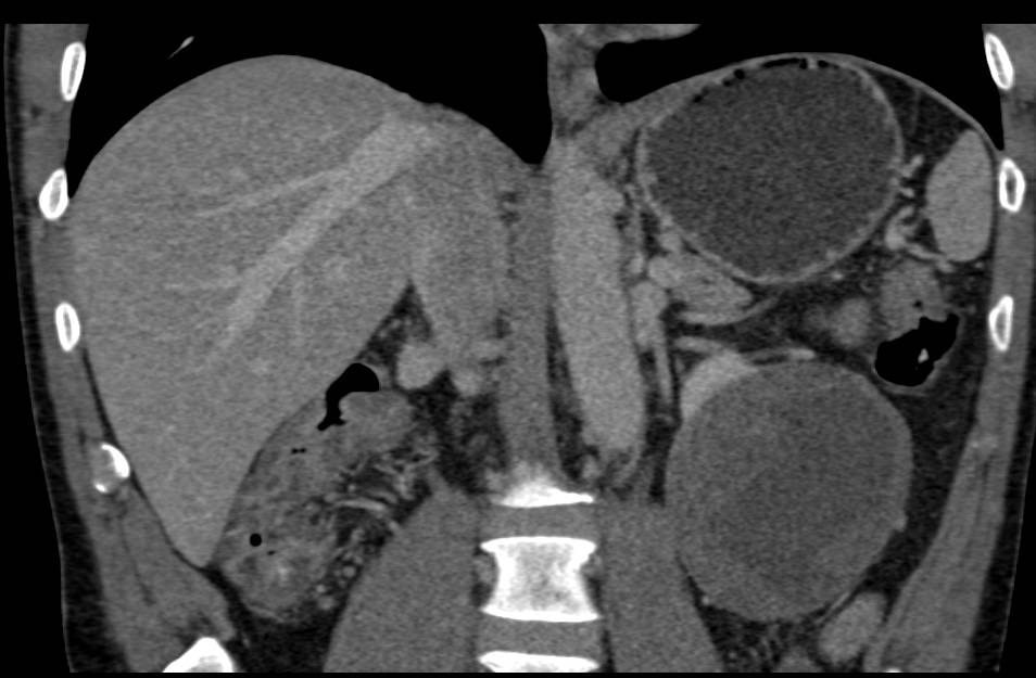 Cystic Renal Cell Carcinoma - CTisus CT Scan