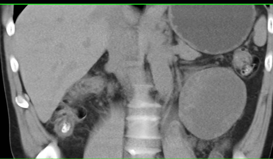 Cystic Left Renal Cell Carcinoma - CTisus CT Scan