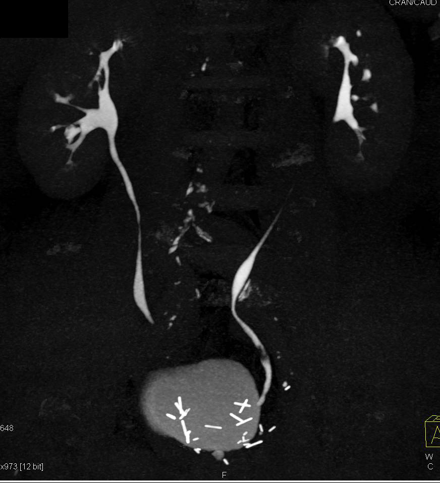 Transitional Cell Carcinoma of the Left Ureter on CT Urograms - Kidney ...