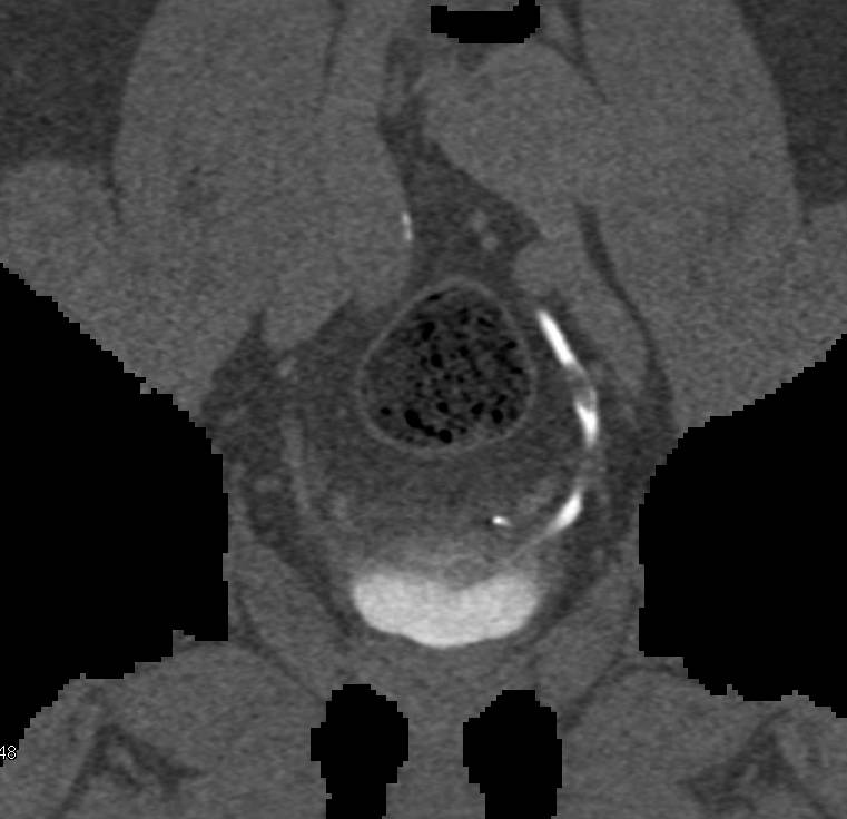 Transitional Cell Carcinoma of the Left Ureter on CT Urograms - CTisus CT Scan