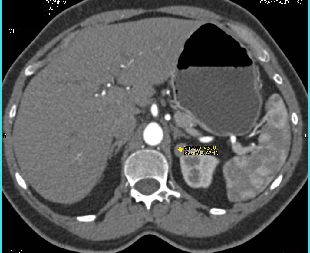 Small Renal Cell Carcinoma and Vascular Pancreas Lesions - CTisus CT Scan