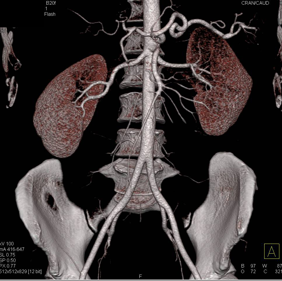 3D CTA of Normal Renal Donor - CTisus CT Scan