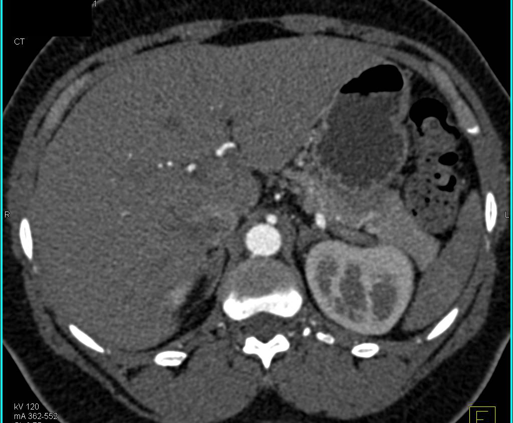 Bilateral Acute Pyelonephritis - CTisus CT Scan