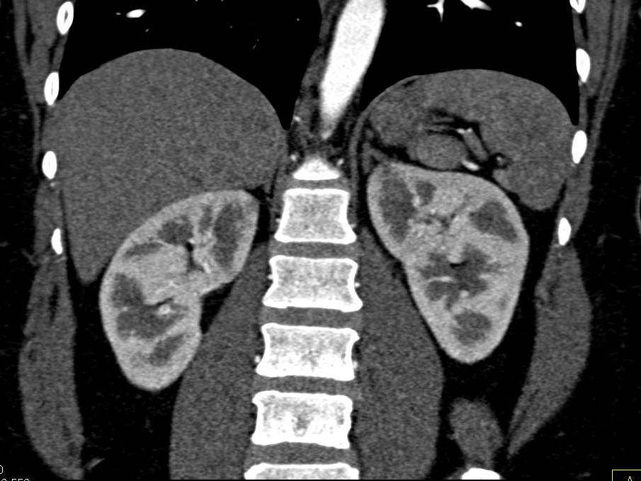 Acute Pyelonephritis not Defined on Early Phase Images - CTisus CT Scan