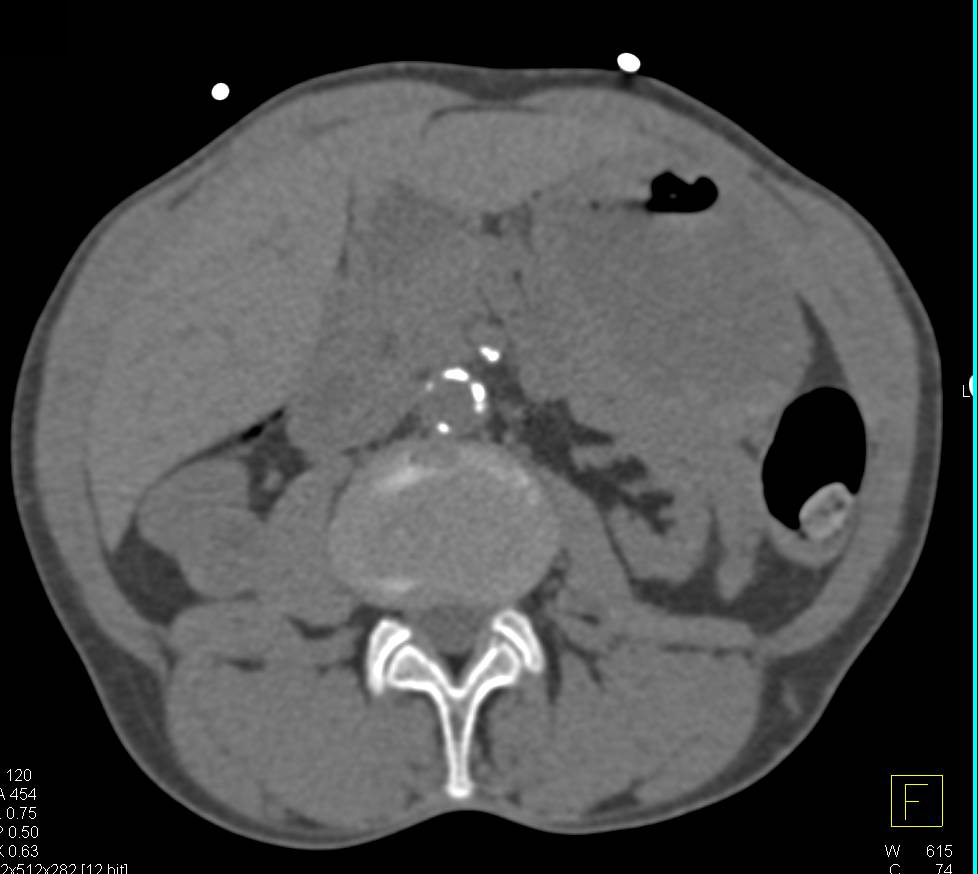 Incidental Renal Cell Cancer - CTisus CT Scan