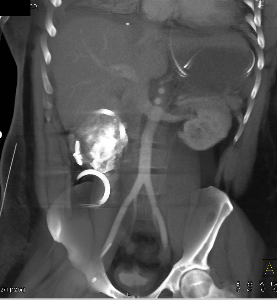 Contrast Extravasation Near the Kidney - CTisus CT Scan