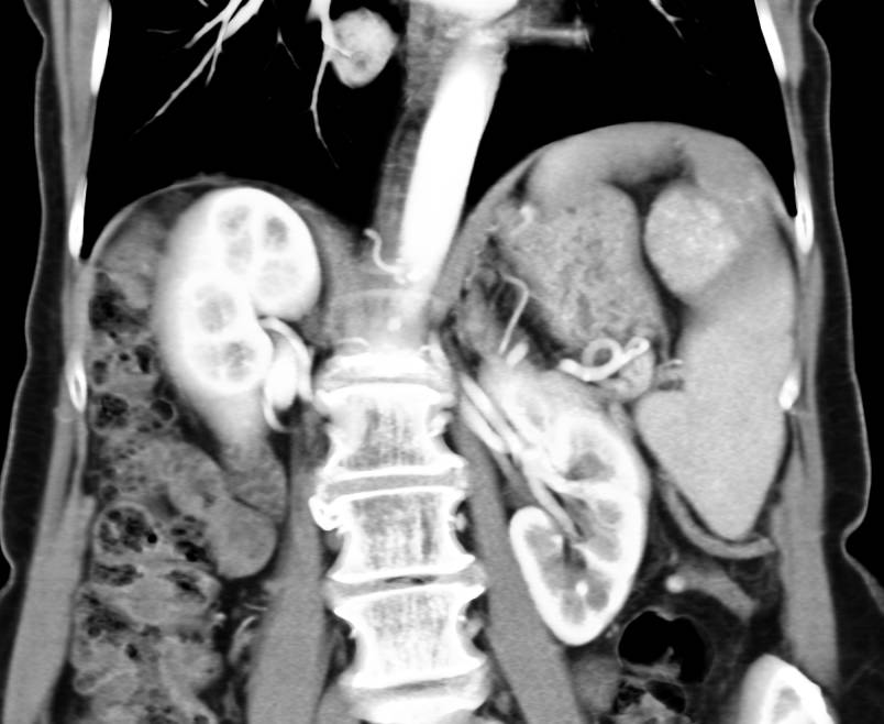 Recurrent Renal Cell Carcinoma to the Liver - CTisus CT Scan