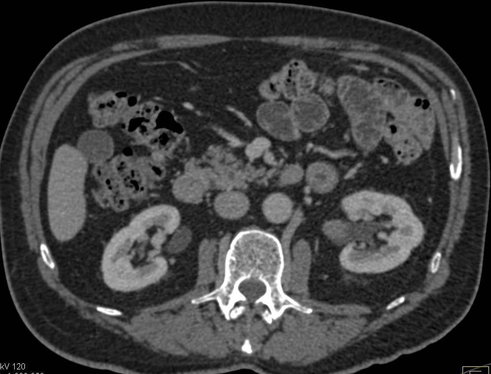 Transitional Cell Carcinoma Left Renal Pelvis - CTisus CT Scan