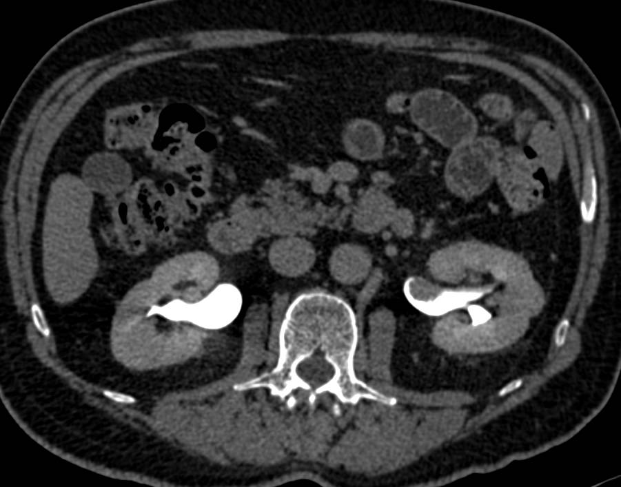 Polypoid Mass in Left Renal Pelvis was a Transitional Cell Carcinoma - CTisus CT Scan