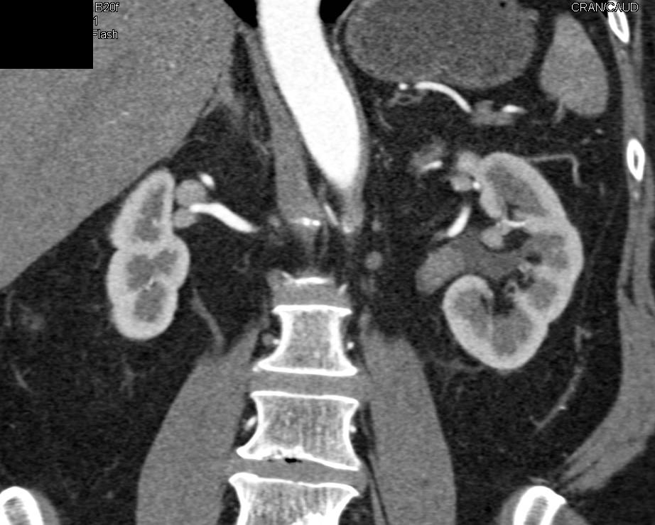 Polypoid Mass in Left Renal Pelvis was a Transitional Cell Carcinoma ...