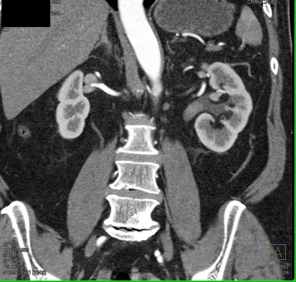 Polypoid Transitional Cell Carcinoma in the Left Renal Pelvis - CTisus CT Scan