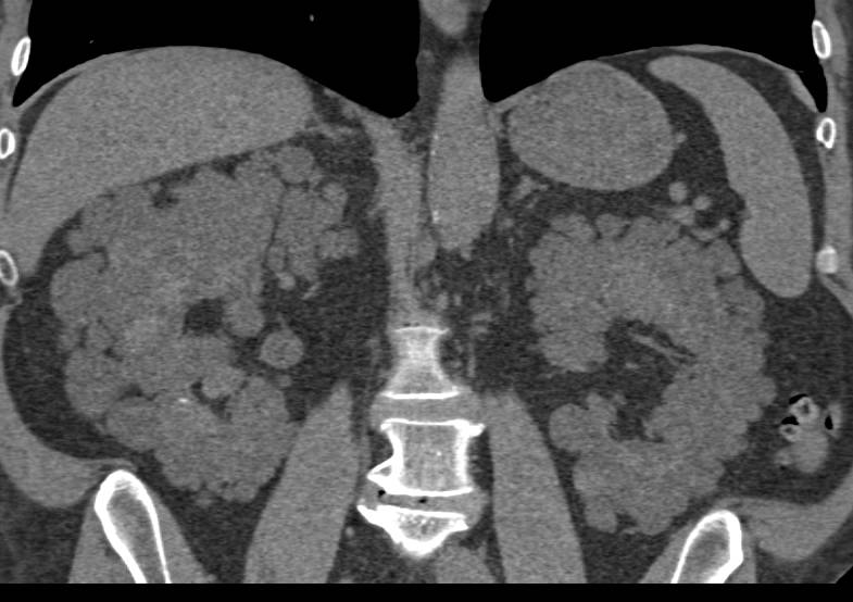 Polycystic Kidney Disease - CTisus CT Scan