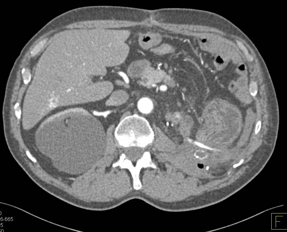 Left Nephrectomy with Renal Cell Carcinoma with Recurrence in Left Psoas Muscle - CTisus CT Scan